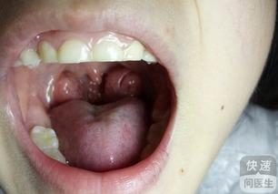 扁桃腺肿可以吃哈密瓜吗,适宜还是禁忌？